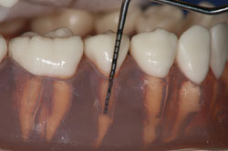 歯周病の治療とは